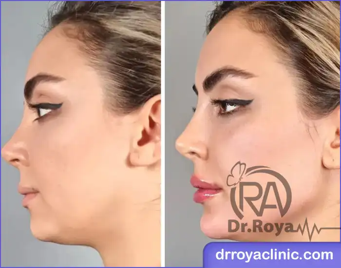 مزایای تزریق ژل گونه