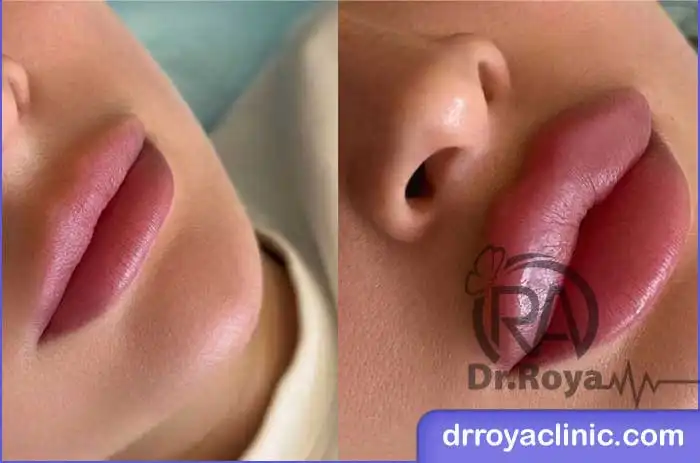 مزایای تزریق ژل لب روسی برای فرم ‌دهی طبیعی لب ‌ها