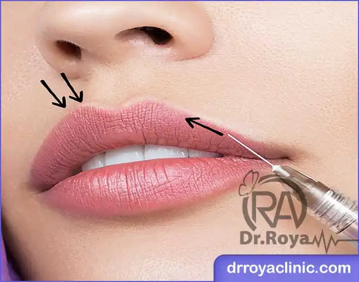 ژل لب روسی در شاهین شهر