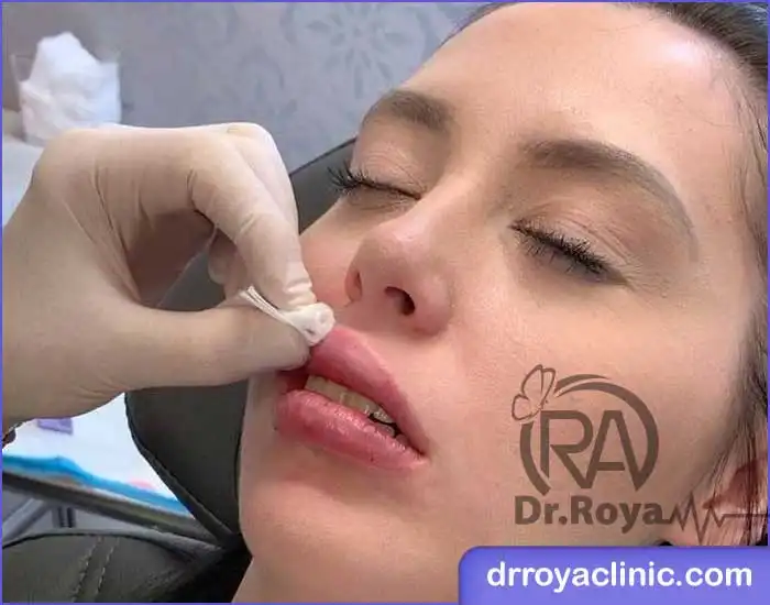 مراحل تزریق ژل لب روسی