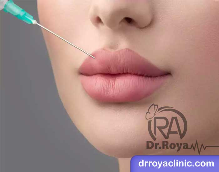 مراحل تزریق ژل لب روسی در اصفهان