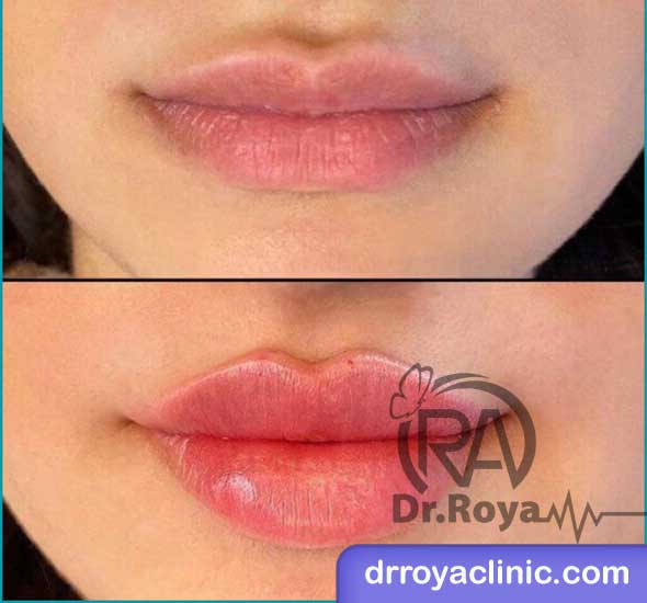 مزایای ژل لب روسی نسبت به سایر روش ‌ها