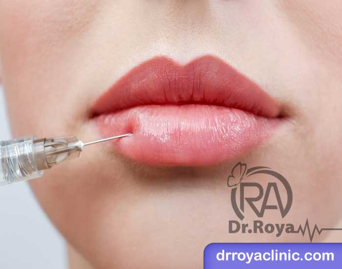 هزینه تزریق ژل لب روسی در اصفهان