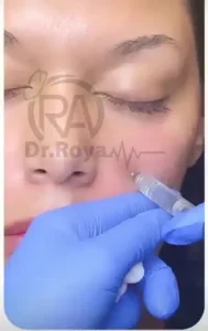 فیلر گونه دکتر رویا تقی پور