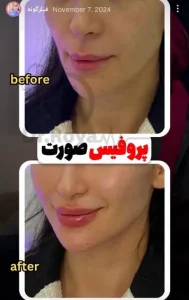 فیلر گونه دکتر رویا تقی پور
