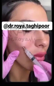 فیلر گونه دکتر رویا تقی پور