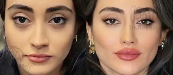 بهترین دکتر تزریق ژل لب روسی در شاهین شهر