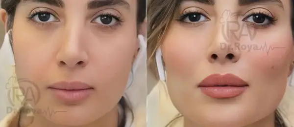 بهترین دکتر تزریق ژل لب روسی در اصفهان