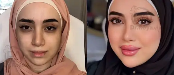 بهترین دکتر تزریق ژل لب روسی در اصفهان