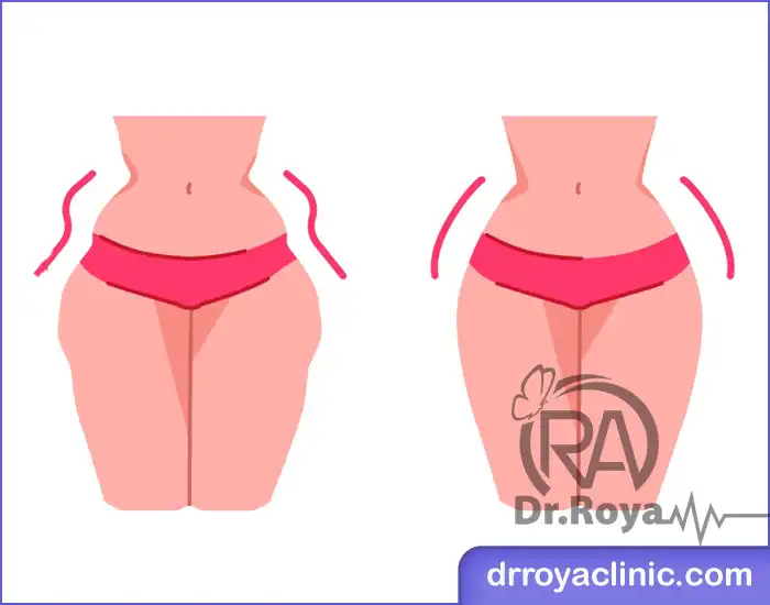 انواع فیلر بدن در زرین شهر