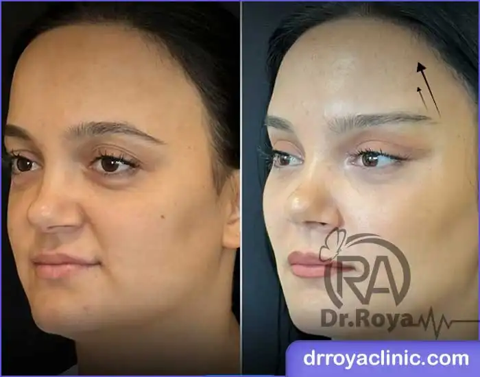 کلینیک زیبایی رویایی آبی برای لیفت ابرو در شاهین شهر