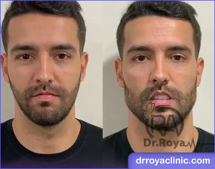 هزینه زاویه ‌سازی صورت در شاهین شهر