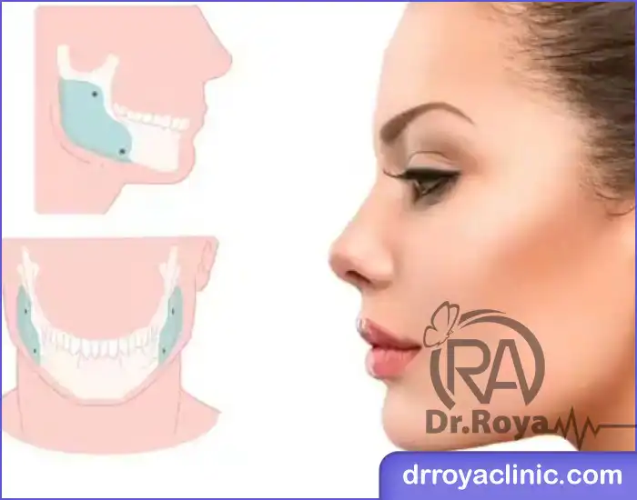 زاویه ‌سازی صورت با پروتز فک