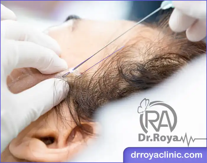 زاویه سازی صورت در شهرکرد با ژل و نخ