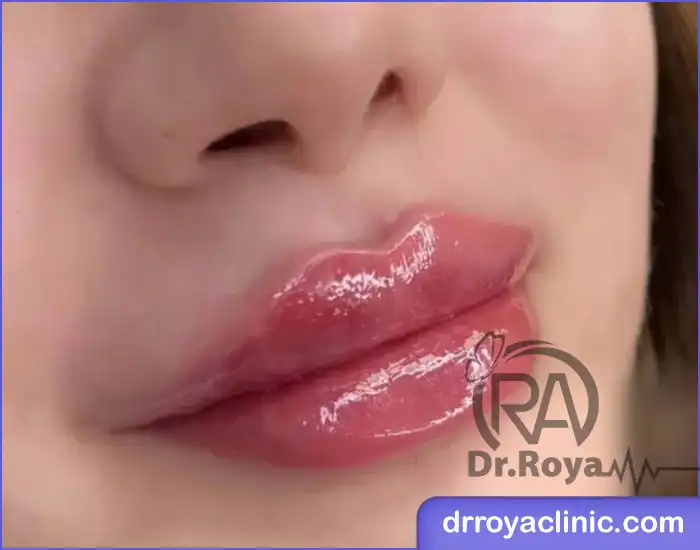 ژل لب طبیعی یا نچرال