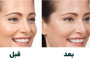 لیفت ابرو در شاهین شهر