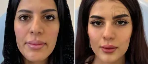 بهترین دکتر زاویه سازی صورت در شاهین شهر 