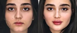 بهترین دکتر زاویه سازی صورت در شاهین شهر 