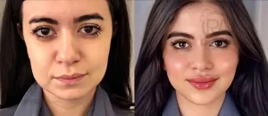 بهترین دکتر زاویه سازی صورت در شاهین شهر 