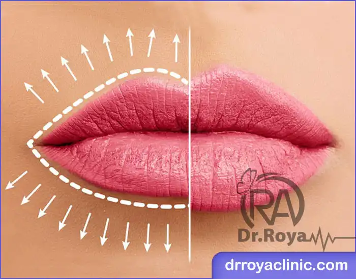 ژل لب عروسکی یا باربی