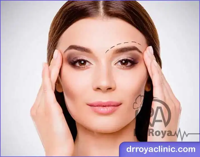 لیفت ابرو اندوسکوپیک