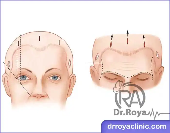 نحوه انجام لیفت ابرو اندوسکوپیک
