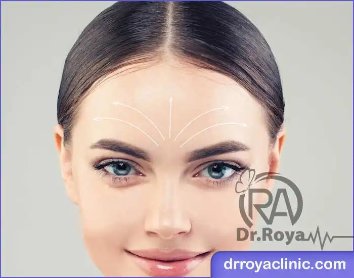 مزایای لیفت ابرو اندوسکوپیک