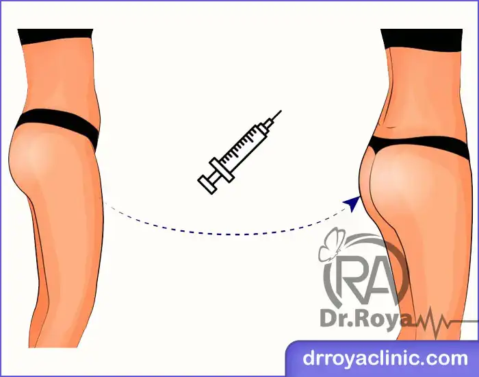 مزایای تزریق ژل به باسن در اهواز