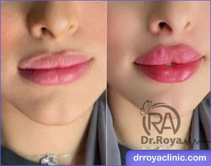 هزینه تزریق ژل استایلج