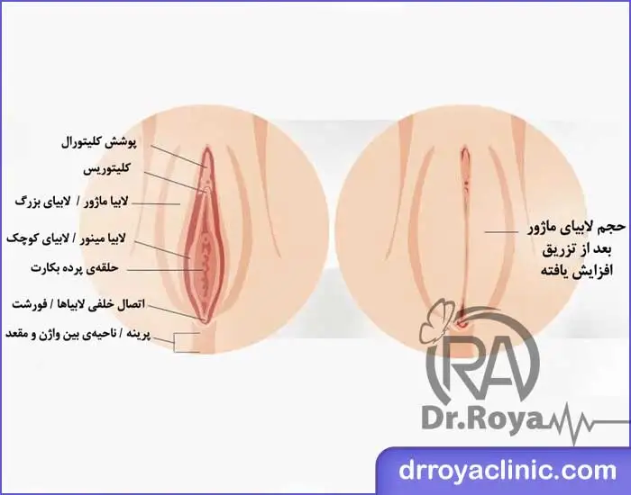 هزینه فیلر بیکینی در شاهین شهر