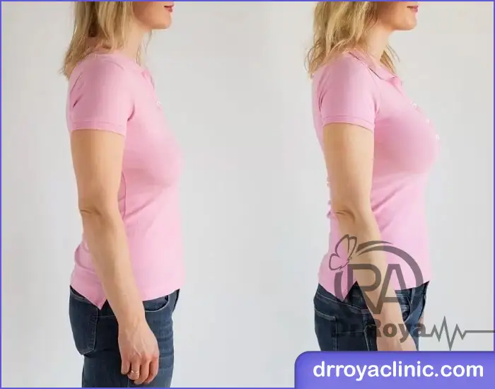 تزریق فیلر سینه در شهرکرد
