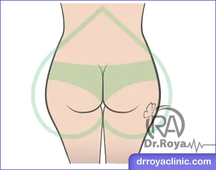 هزینه انجام ژل باسن قلبی