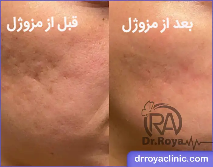 فرایند تزریق مزوژل در اصفهان