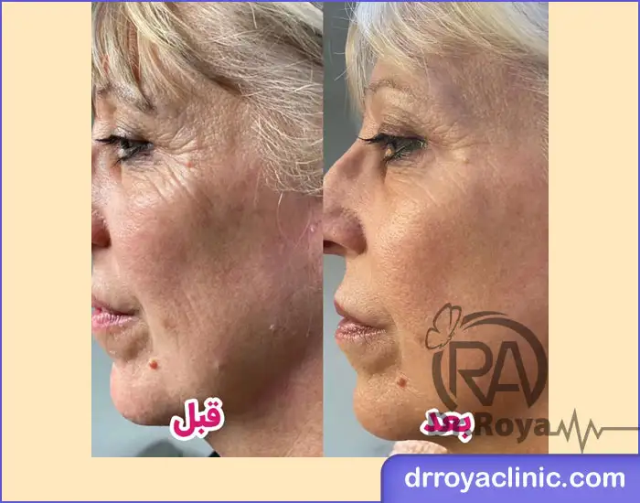 ماندگاری بیشتر تزریق مزو ژل
