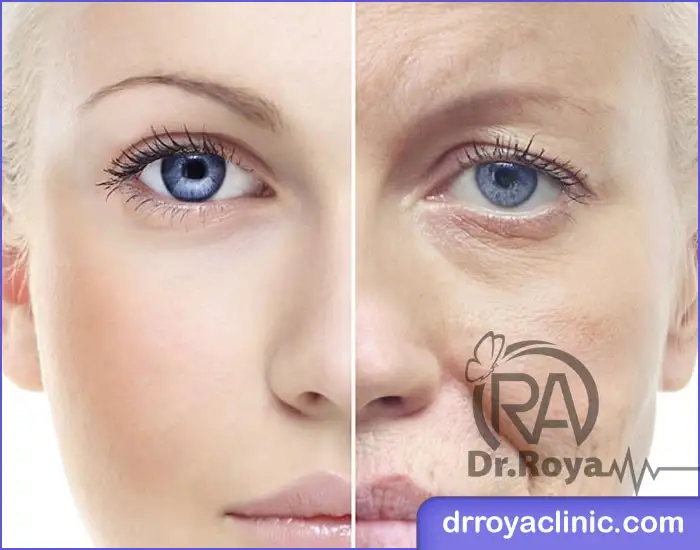 کاربرد تزریق مزوژل در شاهین شهر