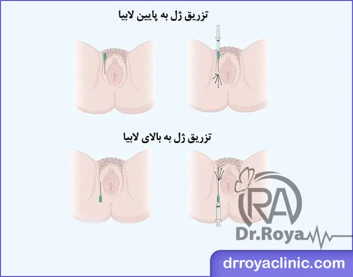 تزریق ژل به واژن در شهرکرد
