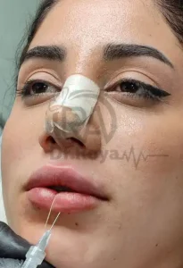بهترین دکتر تزریق ژل لب روسی در شاهین شهر