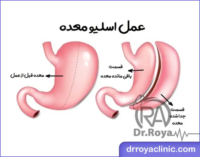 عوارض اسلیو معده