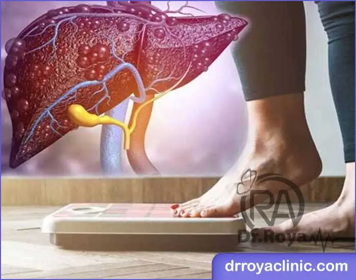 کاهش وزن درمان اصلی کبد چرب