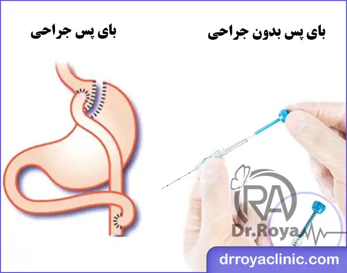 بای پس بدون جراحی
