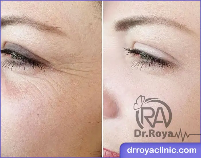 کاربردهای پلاسما‌تراپی پوست