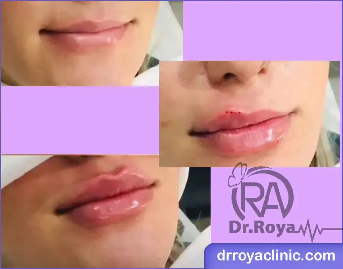 هزینه تزریق ژل در شهرکرد