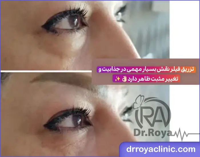 بهترین پزشک تزریق فیلر