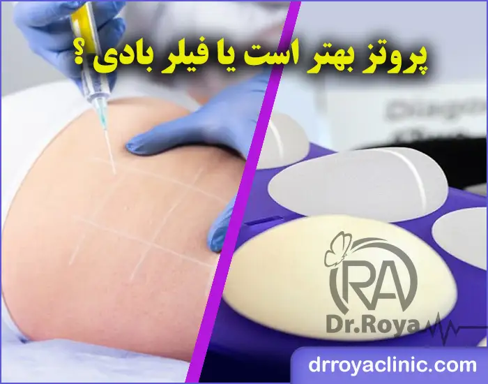 پروتز بهتر است یا فیلر بادی ؟
