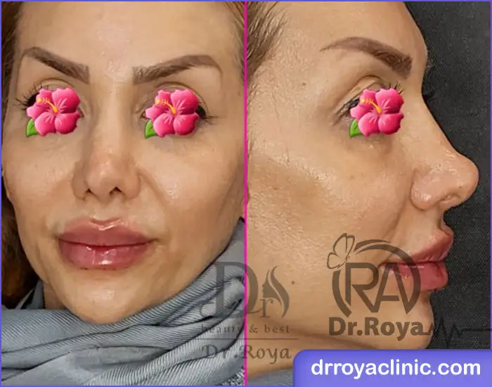 هزینه یک سی سی ژل لب در اصفهان