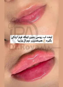 فیلر لب در اصفهان