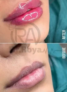 حجم دهی لب در صفهان