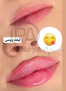زیبایی لب در اصفهان