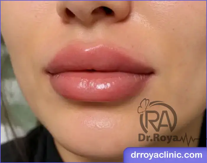 چه کارهایی باعث تشدید ورم بعد از ژل لب میشود؟