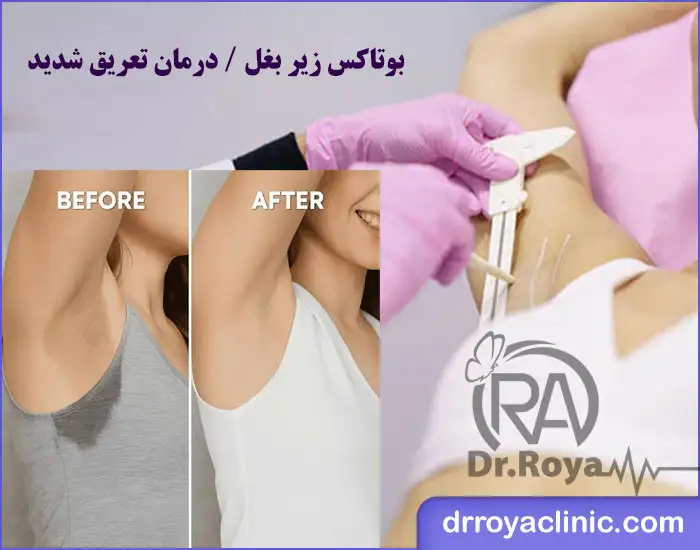 بوتاکس زیر بغل در شاهین‌ شهر